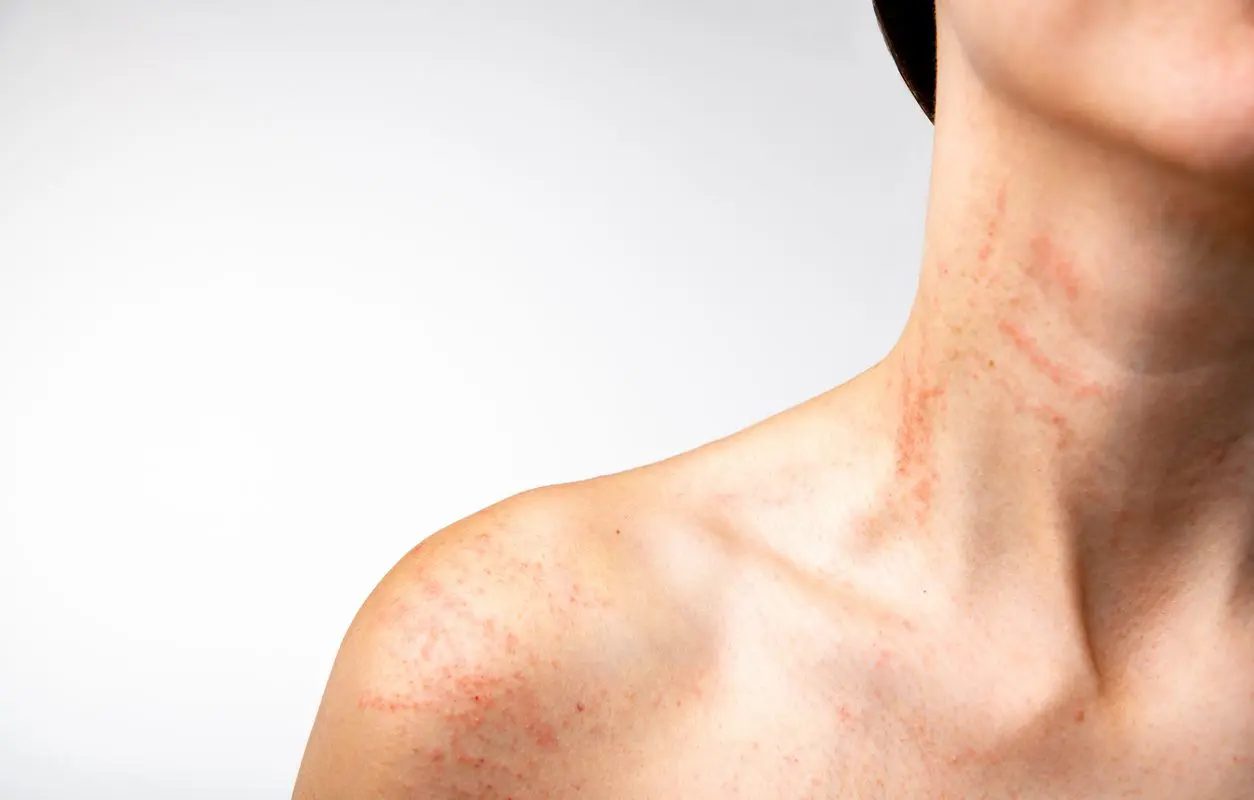 Common Skin Rashes: Causes and Effective Treatments